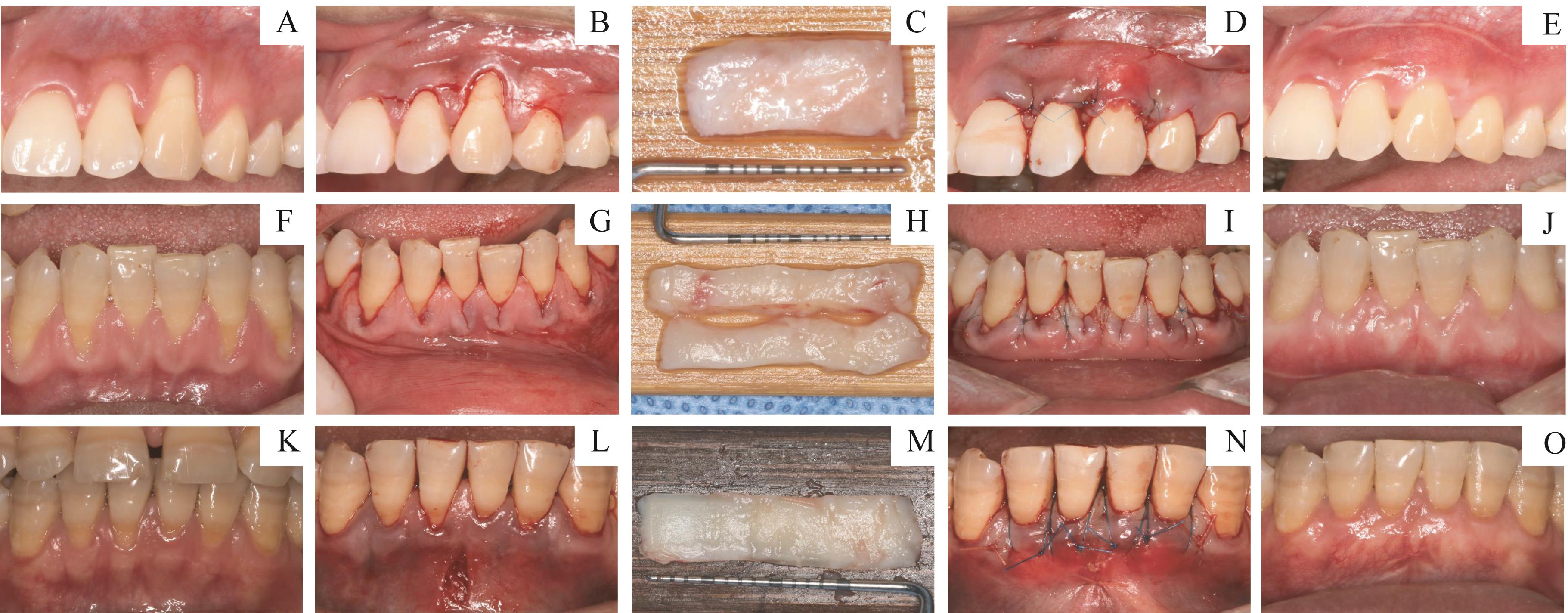 牙科学生学习教学模式展示牙齿、牙根、牙龈、牙龈疾病、蛀牙和牙菌斑。照片摄影图片_ID:309833641-Veer图库