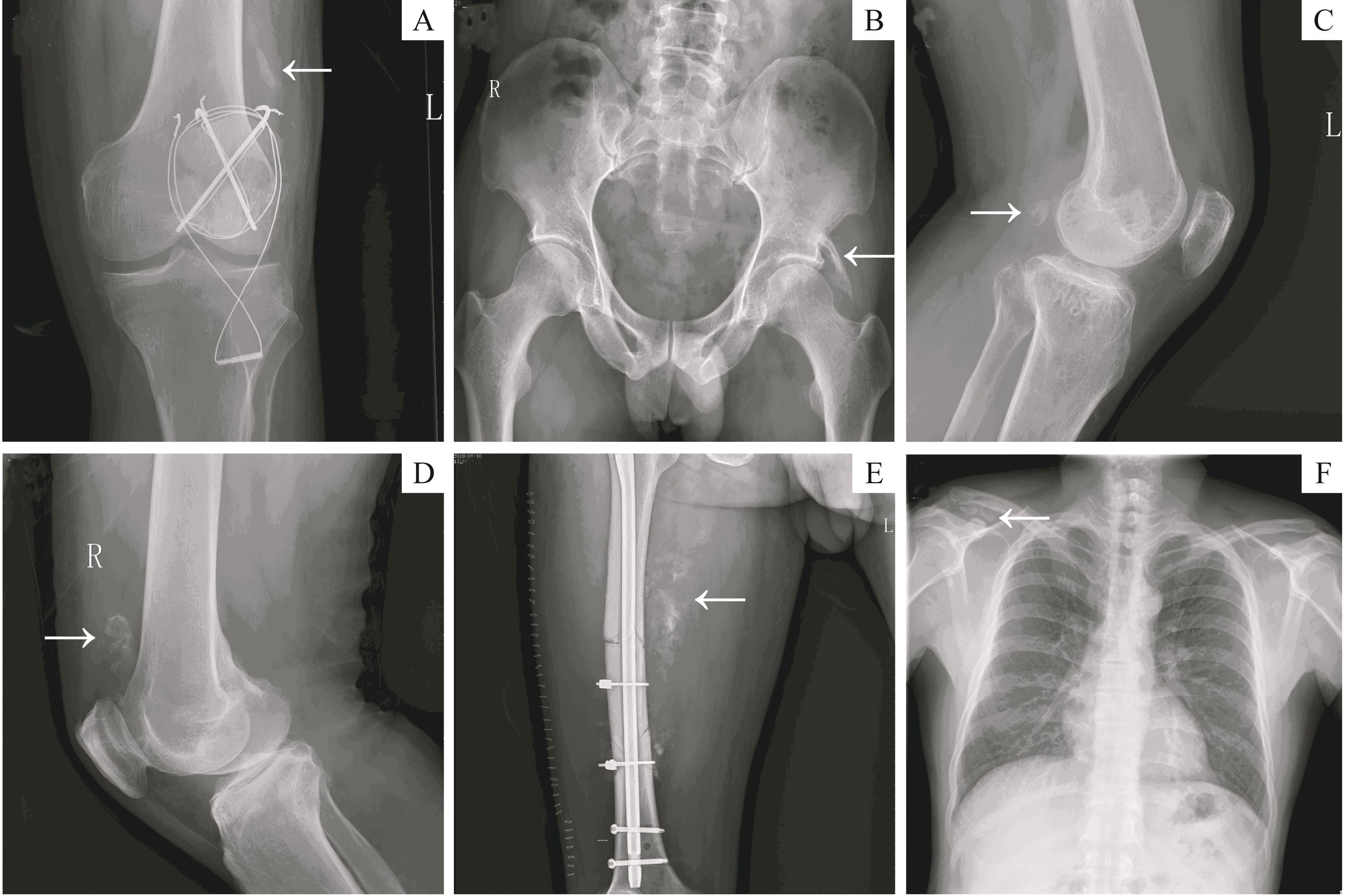 跖骨榫卯形截骨短缩术治疗儿童巨趾畸形的疗效分析|榫卯|患儿|固定|跖骨|愈合|-健康界